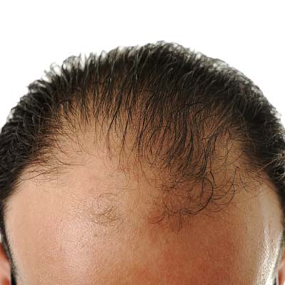 does hair regrow with pcos